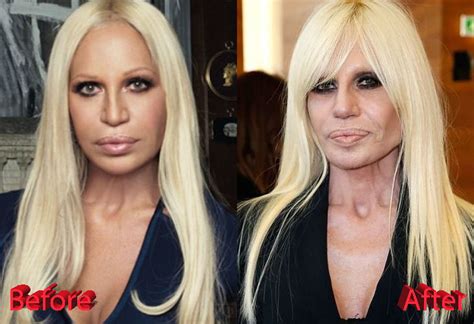 donatella versace è.italiana|donatella versace before and after surgery.